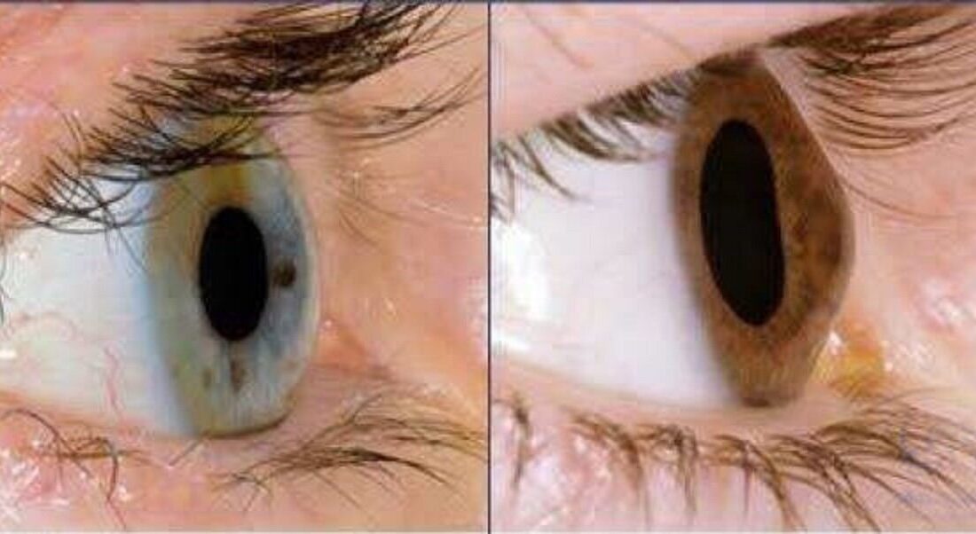 آیا استفاده مداوم از موبایل و لپ‌تاپ باعث قوز قرنیه می‌شود؟