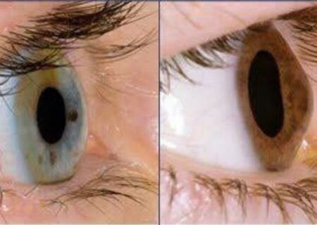 آیا استفاده مداوم از موبایل و لپ‌تاپ باعث قوز قرنیه می‌شود؟