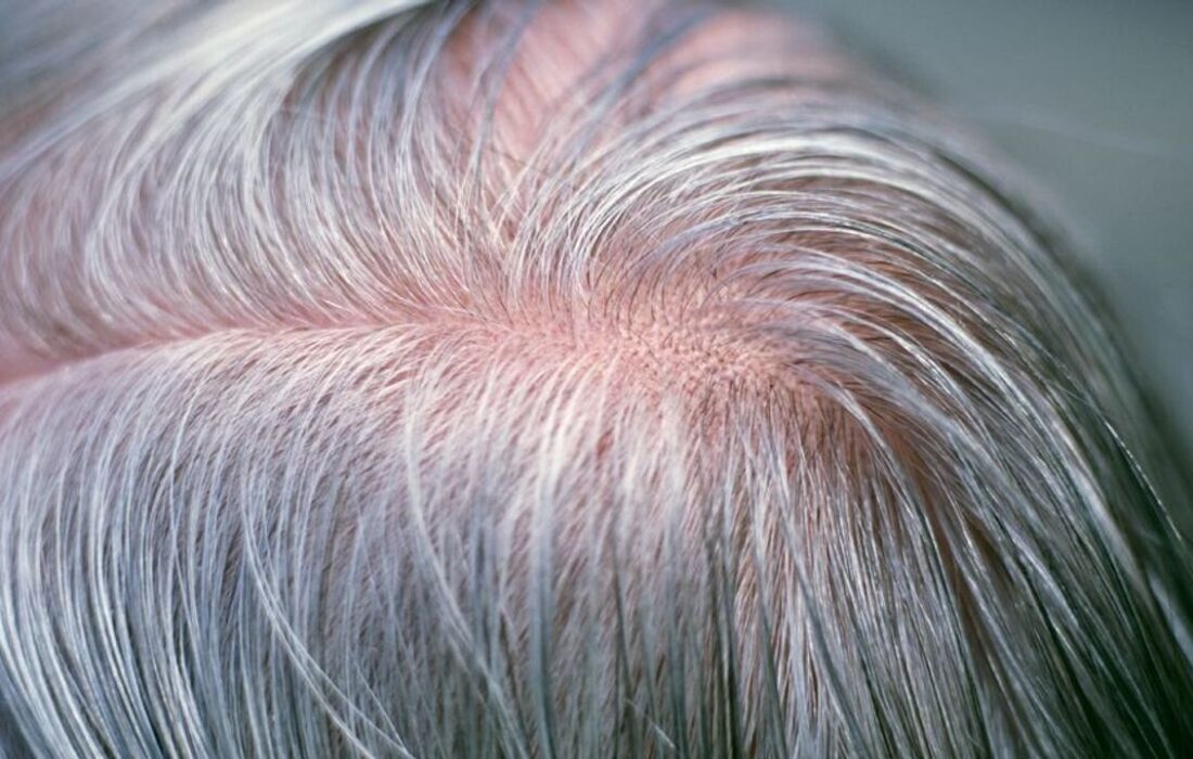 آیا می‌توان جلوی سفید شدن موها را گرفت؟/ دلیل سفیدی مو در نواحی شقیقه‌ها/ چه دارو و مکملی اثر قطعی بر رفع سفیدی مو دارد؟