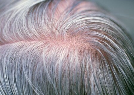 آیا می‌توان جلوی سفید شدن موها را گرفت؟/ دلیل سفیدی مو در نواحی شقیقه‌ها/ چه دارو و مکملی اثر قطعی بر رفع سفیدی مو دارد؟