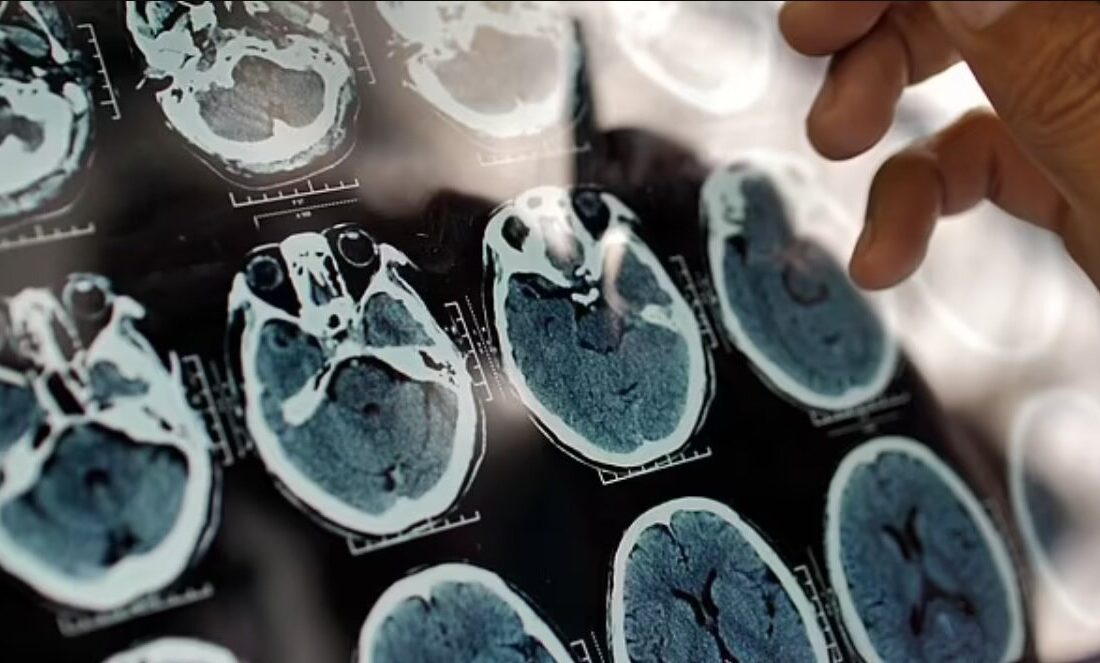 ۵ علامت هشدار دهنده پیری زودرس مغز