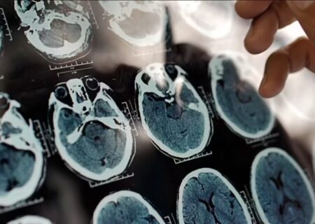 ۵ علامت هشدار دهنده پیری زودرس مغز